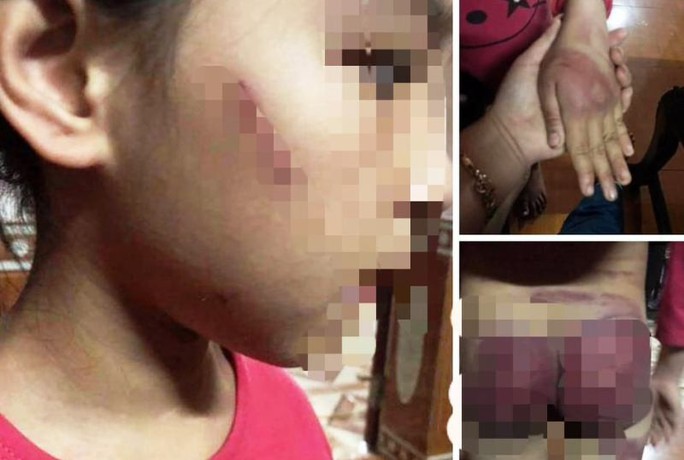 Mẹ rớt nước mắt thấy con gái 8 tuổi bị bố bạo hành thâm tím khắp người - Ảnh 3.