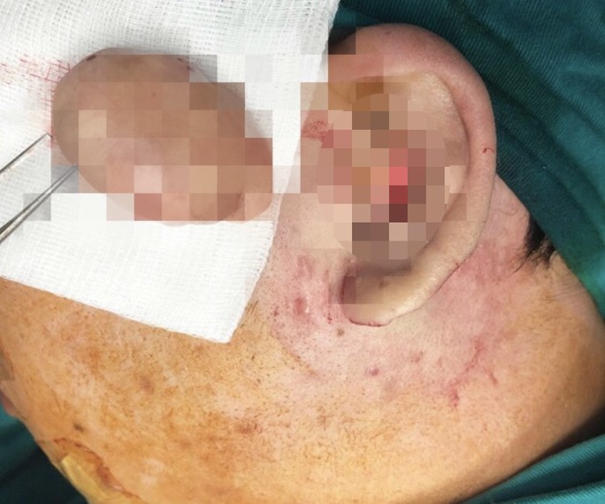 Đeo khuyên tai cho ngầu, nam sinh khổ sở vì biến dạng tai súp lơ - Ảnh 1.