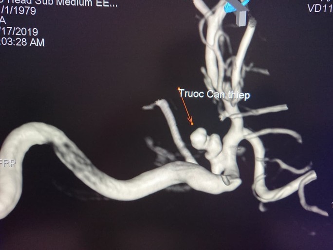 Thả 5 coil vào túi phình mạch máu não cứu nữ bệnh nhân đang sùi bọt mép - Ảnh 2.