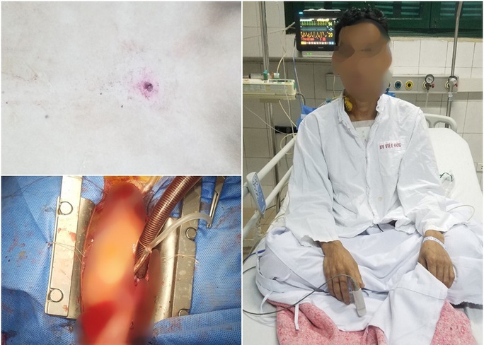 Sửa súng săn, người đàn ông bị đạn găm vào động mạch chủ ở ngực - Ảnh 2. Sửa súng săn, người đàn ông bị đạn găm vào động mạch chủ ở ngực - Ảnh 2.