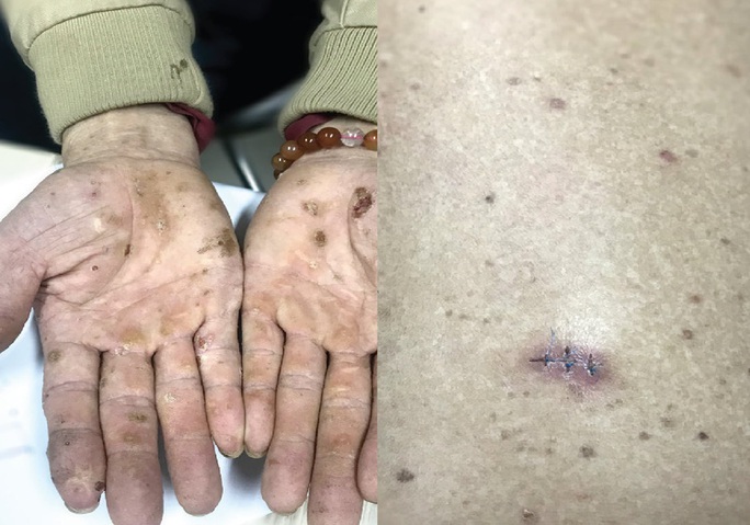Nhiễm độc thạch tín gây ung thư da từ mỹ phẩm không rõ nguồn gốc - Ảnh 1.