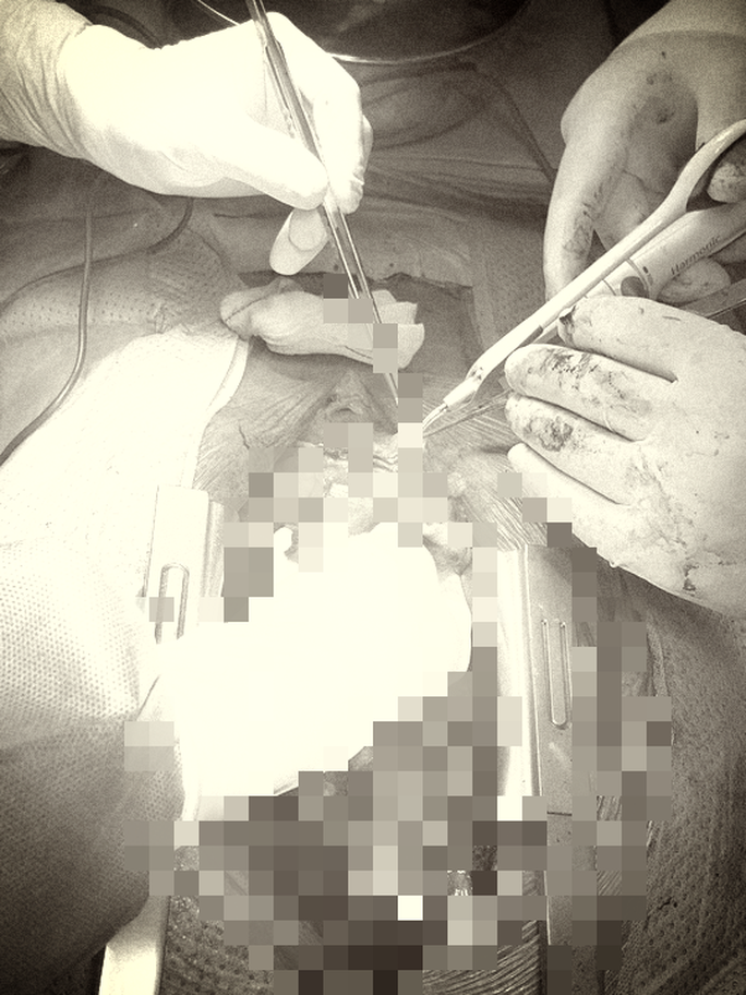 Thêm 1 người đàn ông suýt mất mạng vì hút thuốc lá nhiều - Ảnh 2. Thêm 1 người đàn ông suýt mất mạng vì hút thuốc lá nhiều - Ảnh 2.