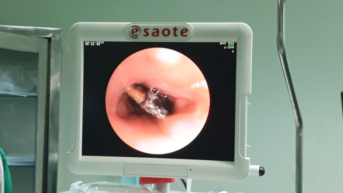 Căng thẳng lấy hạt hồng xiêm nằm 27 năm trong phế quản của người phụ nữ - Ảnh 1. Căng thẳng lấy hạt hồng xiêm nằm 27 năm trong phế quản của người phụ nữ - Ảnh 1.