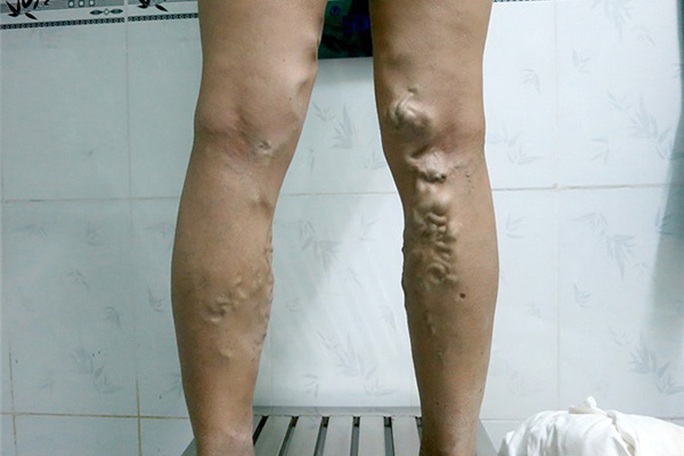Bác sĩ điểm danh những nghề dễ mắc bệnh suy giãn tĩnh mạch chi - Ảnh 3. Bác sĩ điểm danh những nghề dễ mắc bệnh suy giãn tĩnh mạch chi - Ảnh 3.