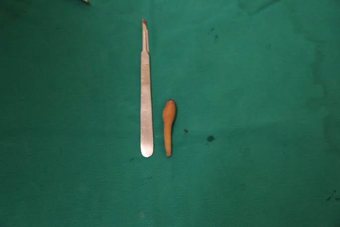 Phẫu thuật cắt đuôi dài hơn 9 cm cho bé gái 5 tháng tuổi - Ảnh 2.