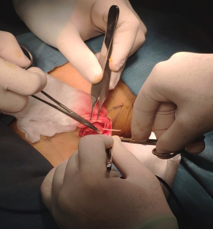 Hóc xương cá 5 tháng nhưng trị bằng cách dân gian, bé gái suýt mất mạng - Ảnh 3. Hóc xương cá 5 tháng nhưng trị bằng cách dân gian, bé gái suýt mất mạng - Ảnh 3.