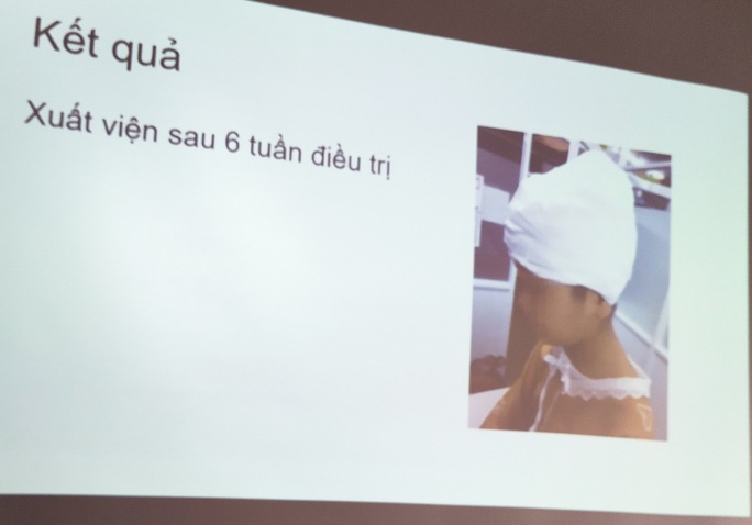 Tóc cuốn vào máy cưa đá, bé gái bị lột hơn một nửa da đầu - Ảnh 2. Tóc cuốn vào máy cưa đá, bé gái bị lột hơn một nửa da đầu - Ảnh 2.