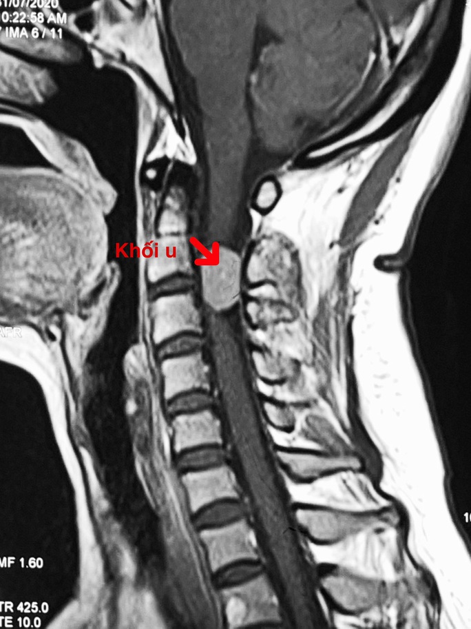 Cân não với ca phẫu thuật khối u chèn ép tủy cổ - Ảnh 1.