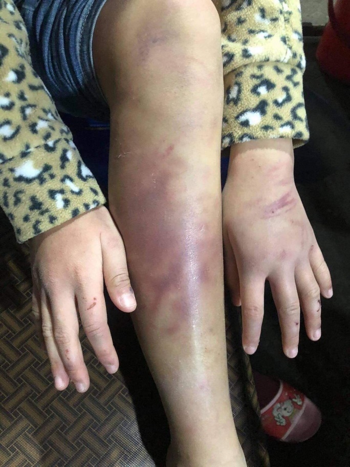 Vụ bạo hành dã man bé gái 12 tuổi: Bị người tình của mẹ xâm hại tình dục nhiều lần? - Ảnh 3.