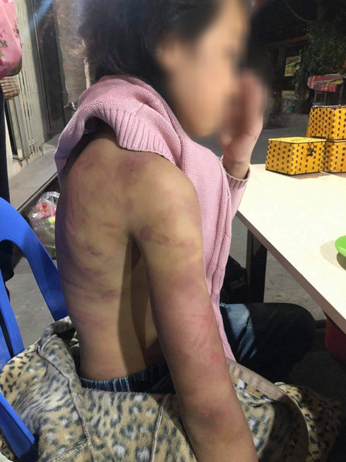 Vụ bạo hành dã man bé gái 12 tuổi: Bị người tình của mẹ xâm hại tình dục nhiều lần? - Ảnh 1.