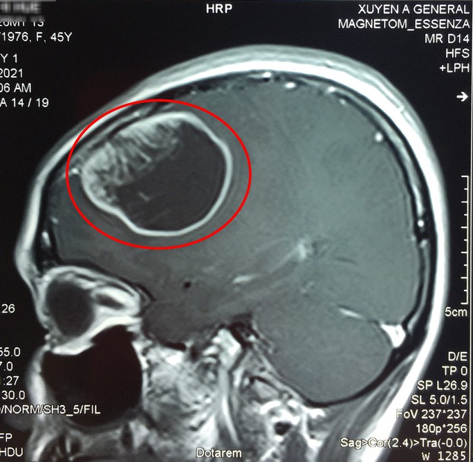 Thường xuyên đau đầu, đi khám phát hiện khối u chèn ép não - Ảnh 1.