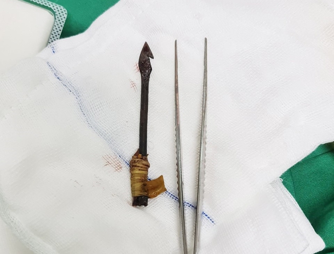 Bé trai 8 tuổi bị mũi tên bắn xuyên mắt, găm sâu vào sọ não - Ảnh 2.