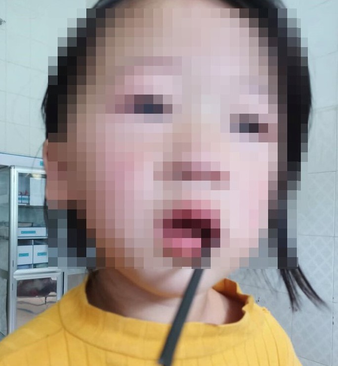 Bé gái 4 tuổi bị thanh sắt dài 20 cm đâm xuyên, mắc kẹt trong khoang miệng - Ảnh 1.