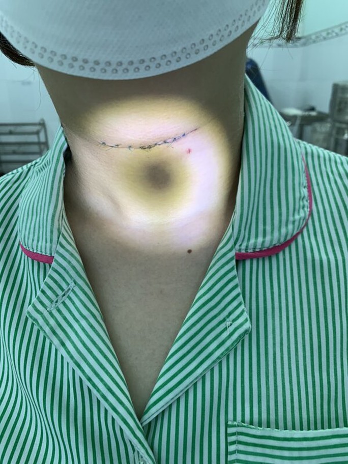 Đau họng, nuốt vướng coi chừng mắc một bệnh từ khi còn là bào thai - Ảnh 2. Đau họng, nuốt vướng coi chừng mắc một bệnh từ khi còn là bào thai - Ảnh 2.