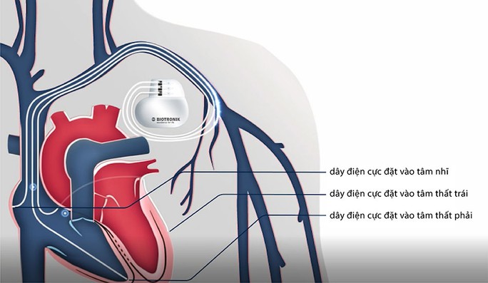 Bệnh nhân suy tim, nằm một chỗ có thể tự đi lại nhờ kỹ thuật hiện đại - Ảnh 1.