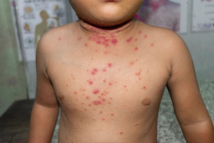 Mỹ phát hiện trẻ sơ sinh mắc bệnh đậu mùa khỉ - Ảnh 1.