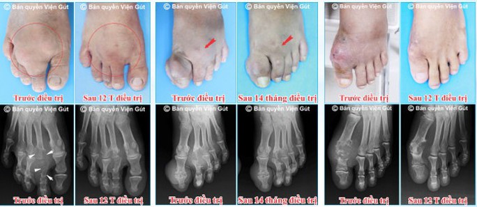 Người bị bệnh gút không còn lo đau nhức do biến chứng - Ảnh 1.