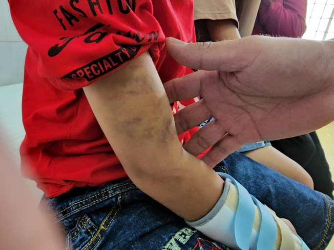 Vụ cháu bé 9 tuổi bị đánh đập dã man: Phát hiện xương bàn tay bị gãy - Ảnh 1.