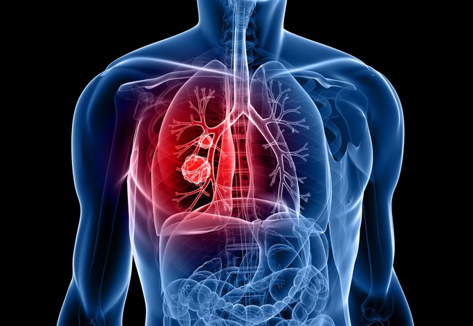 Cảnh báo thứ làm đột biến gien, gây ung thư phổi dù không hút thuốc - Ảnh 1.