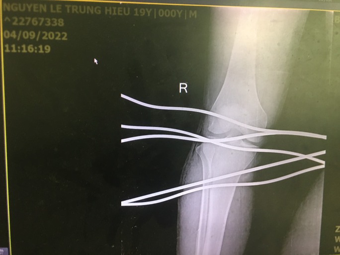 Kinh hoàng cảnh thanh niên bị 5 cây sắt đâm xuyên qua chân - Ảnh 3. Kinh hoàng cảnh thanh niên bị 5 cây sắt đâm xuyên qua chân - Ảnh 3.