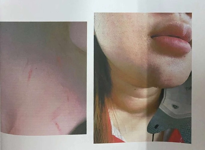 Nữ sinh lớp 12 ở TP HCM tố bị đánh hội đồng - Ảnh 2.