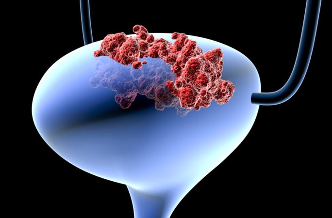Đột phá: Xét nghiệm nước tiểu dự báo ung thư 12 năm trước khi phát bệnh - Ảnh 1.