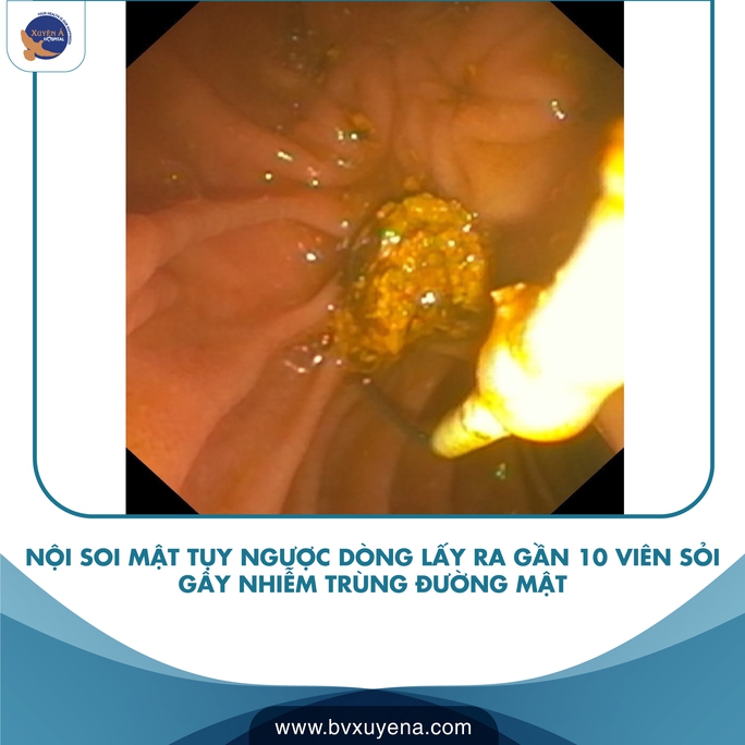 Nguy kịch vì bụng chứa hàng chục viên sỏi - Ảnh 1.