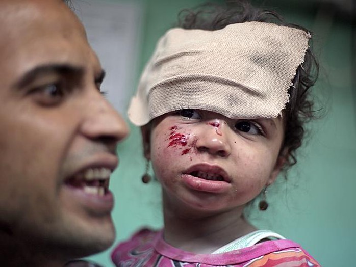 Bé gái Palestine bị thương sau vụ pháo kích của Israel vào trại tị nạn Jabalia sáng  30-7. Ảnh: AP