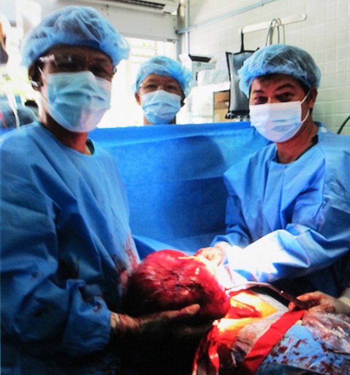 Các bác sĩ phẫu thuật lấy ra khối u 4,5 kg trong ngực bệnh nhân P. (Ảnh do BV Chợ Rẫy cung cấp)