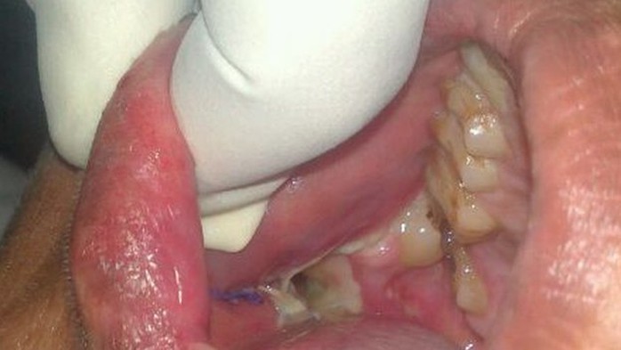 Quá trình phẫu thuật bỏ răng của Ashik