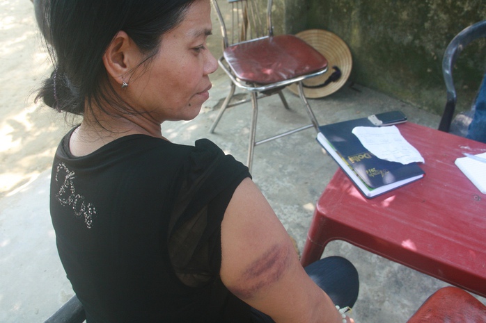 Bà Phạm Thị Tính với vết thương bầm tím trên tay