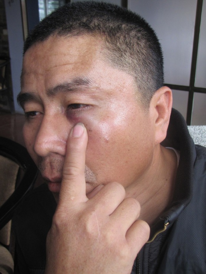 Anh Lê Kim với vết thương ở mắt sau khi bị đánh