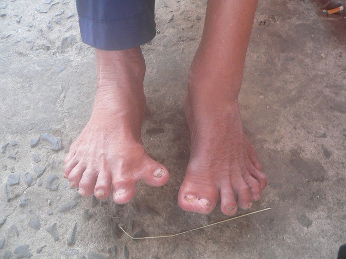 Đôi bàn chân “khủng” của lão Hai Thành có đến 4 ngón cái và 4 ngón út vì nó rất giống nhau.