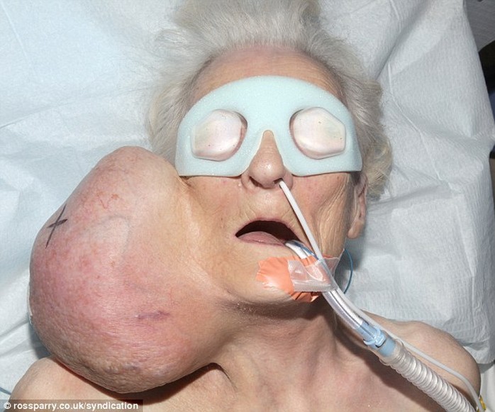 Bà Joyce Haigh, 79 tuổi, với khối u nặng 2kg. Ảnh: Daily Mail