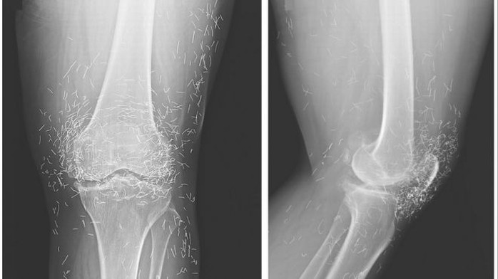 X-quang cho thấy hàng trăm mũi kim vàng trong cơ thể bệnh nhân - Ảnh: Fox News