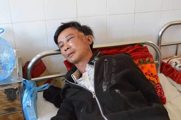 
	Anh Đỗ Vạn Hoa với nhiều vết thương ở mặt đang được điều trị tại Bệnh viện Đa khoa tỉnh Đắk Lắk