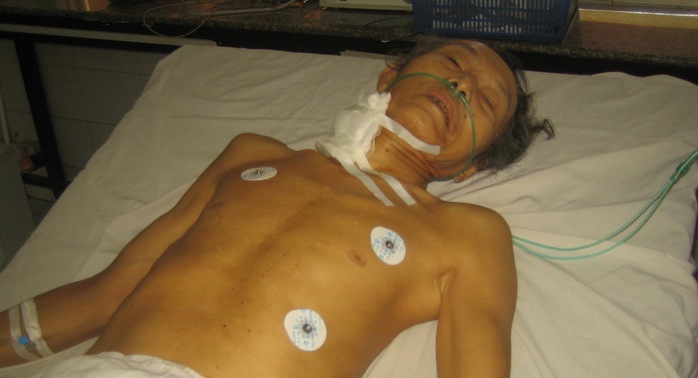 Ông Phạm Văn Bảy đang được cứu chữa tại Bệnh viện Đa khoa tỉnh Bình Phước.