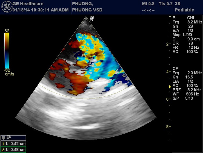 Hình ảnh siêu âm tim của bé N.N.A.P