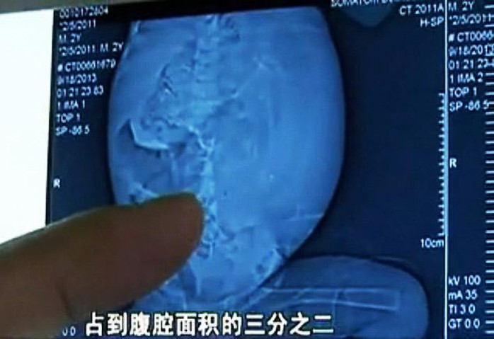 Thai nhi trong bụng Xiao đã hình thành xương sống và tay chân. Ảnh: v.youku.com