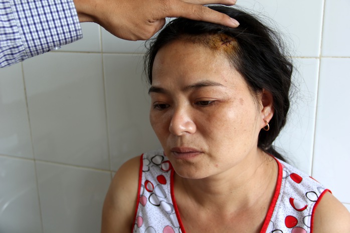 Chị Nguyễn Thị Thúy tố cáo bị chồng hành hung khiến thương tích khắp người