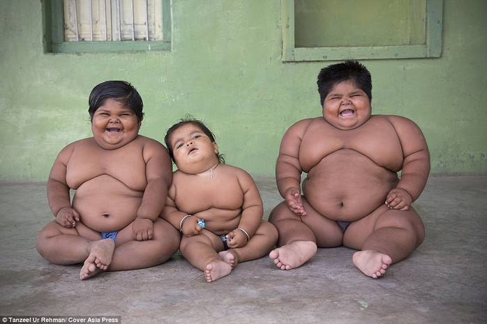 Ba đứa trẻ mắc bệnh lạ khiến cơ thể béo phì bất thường