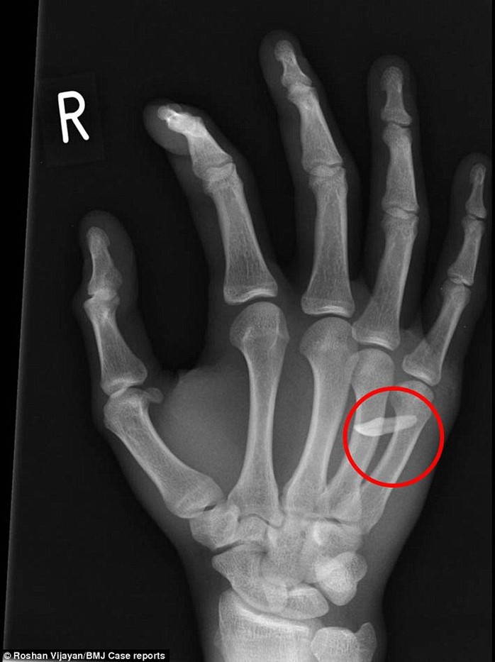 Hình chụp X-quang cho thấy răng cửa mắc trong đốt xương tay