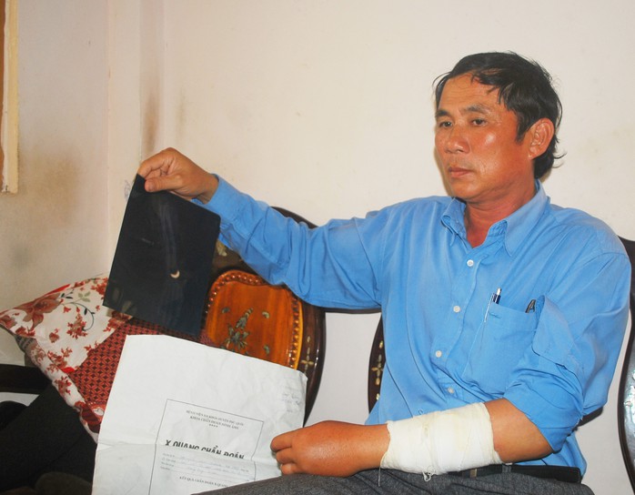 Ông Nguyễn Văn Thương bị giang hồ đánh gãy tay