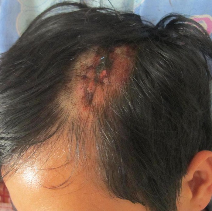 Anh Thuận với vết thương ở trên đầu.