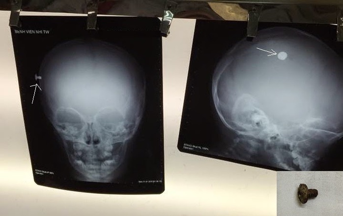 Hình ảnh chiếc đinh vít (đốm trắng) trên phim X quang hộp sọ chụp thẳng và chụp nghiêng và sau khi được gắp ra khỏi đầu bệnh nhi (ảnh dưới phải). Ảnh do bác sĩ cung cấp