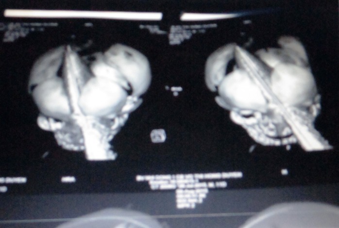 Phim X-quang cho thấy vị trí lưỡi dao xuyên qua vùng sọ, mặt của cháu bé