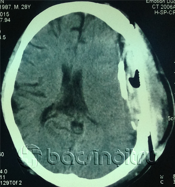 Hình ảnh CT sọ não bệnh nhân