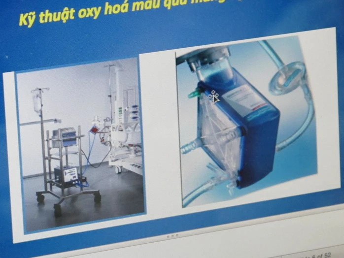 Máy hỗ trợ phương pháp ECMO cho người sắp chết