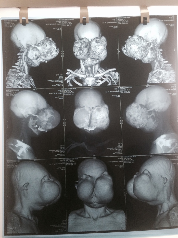 Hình ảnh chụp cắt lớp vi tính khối u khổng lồ của bệnh nhân

 