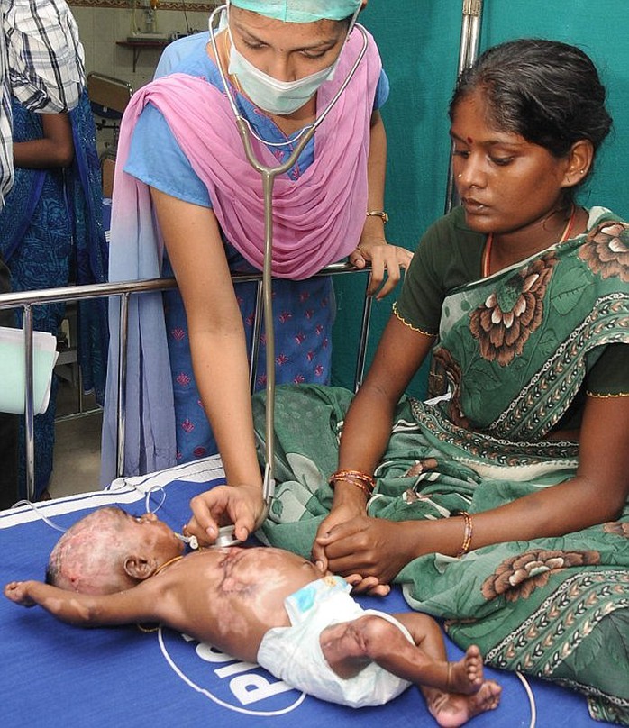 Ms Rajeswari (right), 22, claimed in 2013 that her other son Rahul had also spontaneously combusted